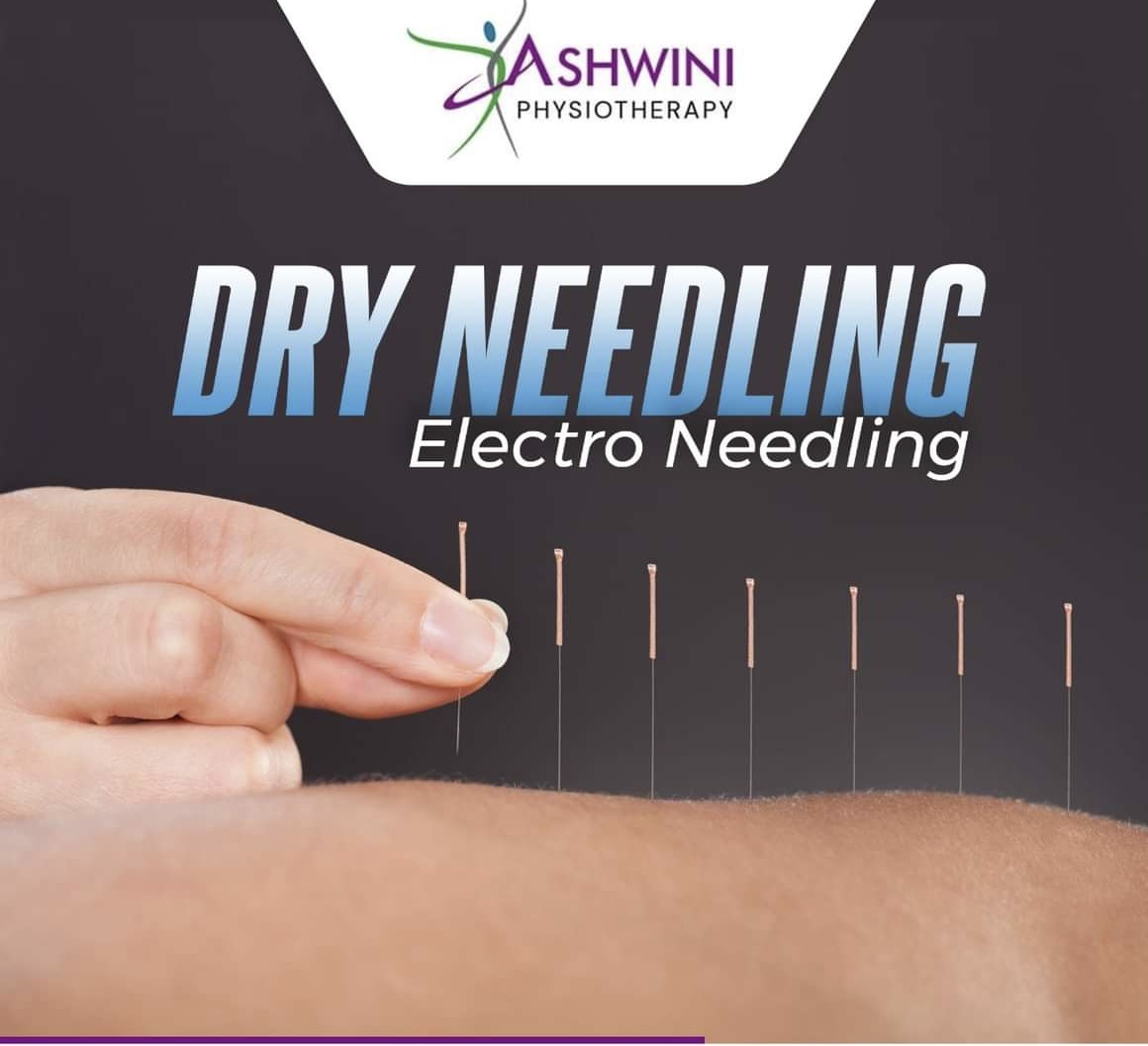 Dry Needling