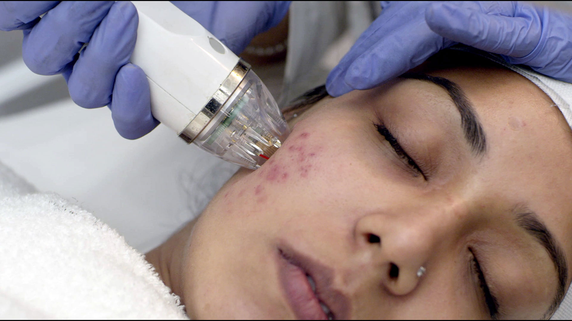 MNRF SKIN TREATMENT