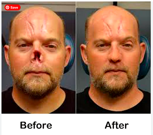 Artificial Nose Prosthesis