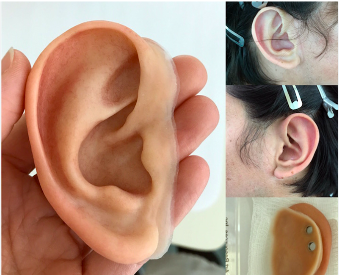 Artificial Ear Prosthesis