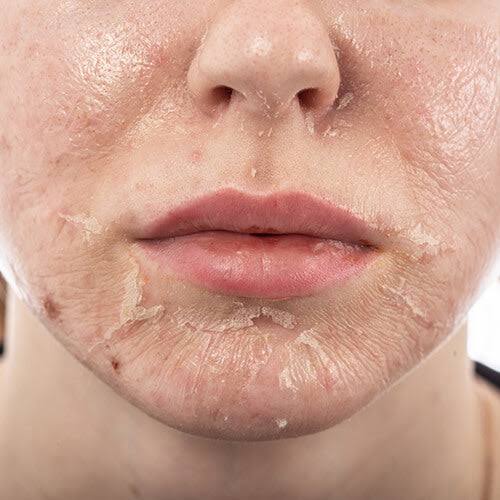 BIO MICRONEEDLING / SPICULING KOREAN SKIN TREATMENT