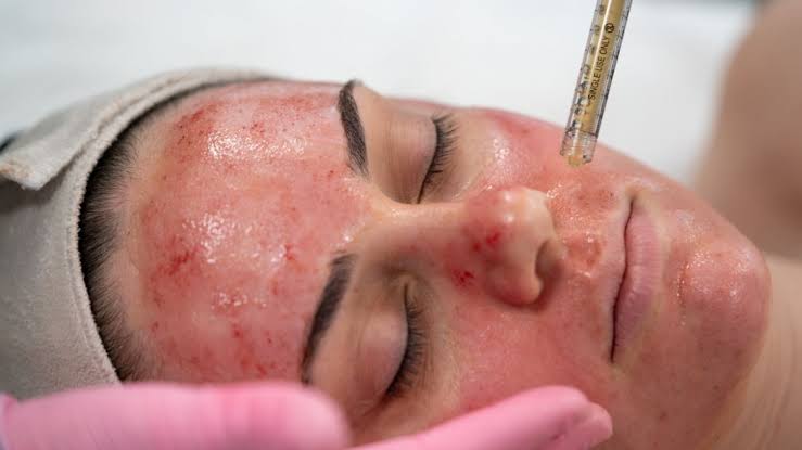 VAMPIRE FACIAL