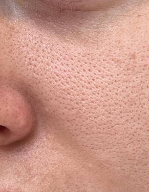 B B PORE LASER