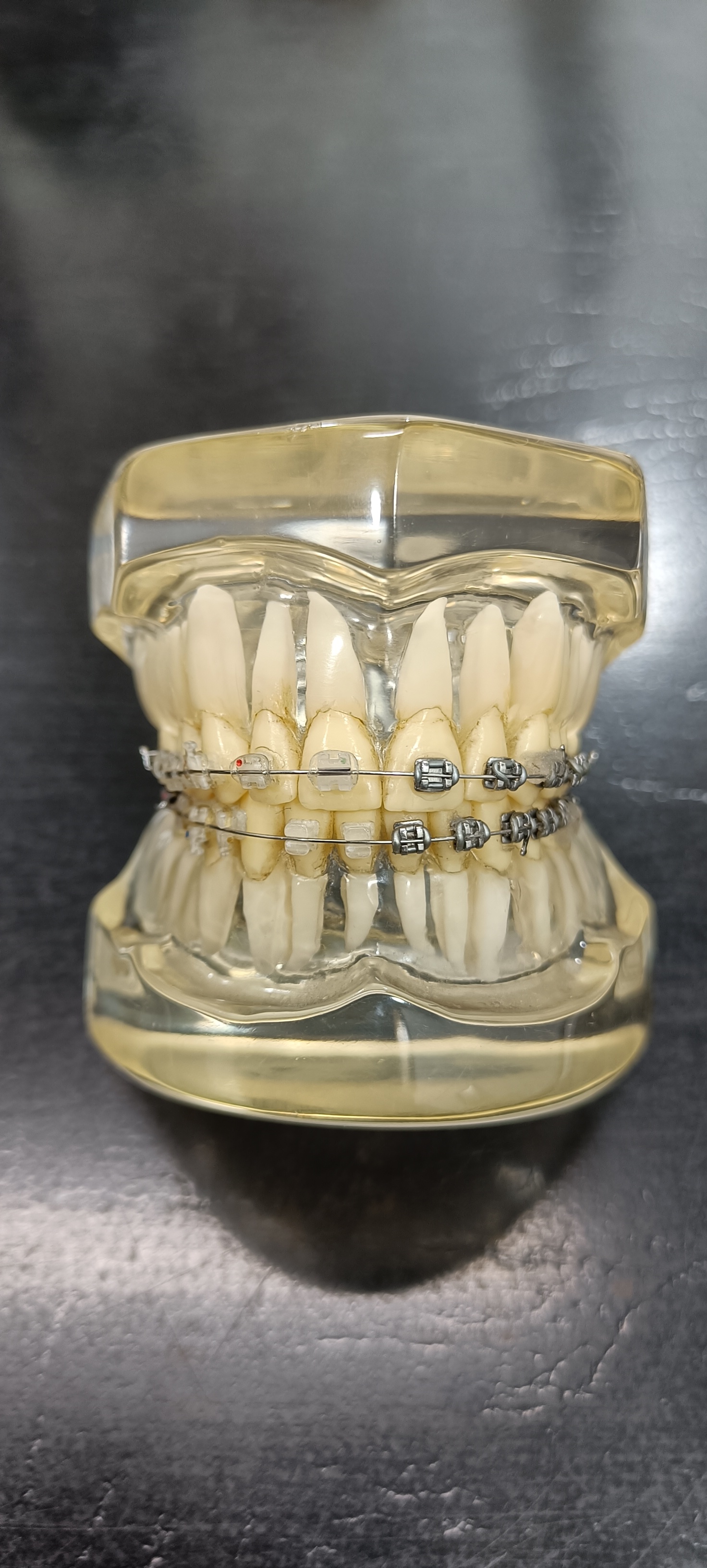 Orthodontic Braces
