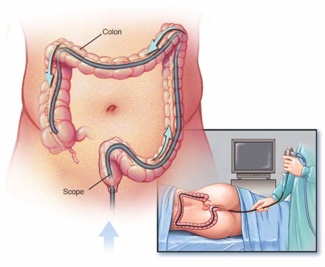 Painless Colonoscopy
