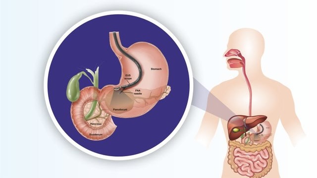 ERCP (Endoscopic Retrograde Cholangiopancreatography )