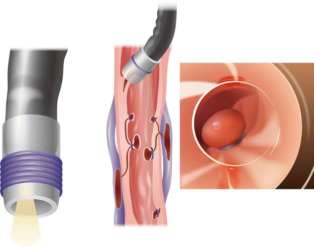 Endoscopic variceal ligation