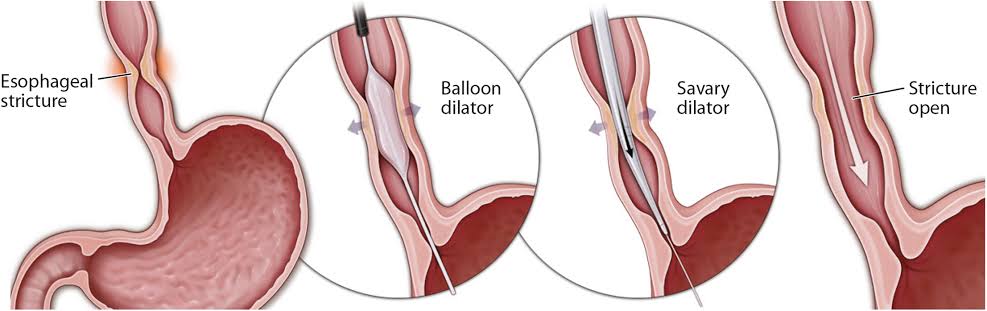 Stricture dilation