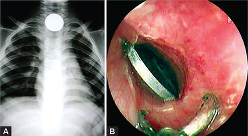 Esophageal Foreign Body Removal