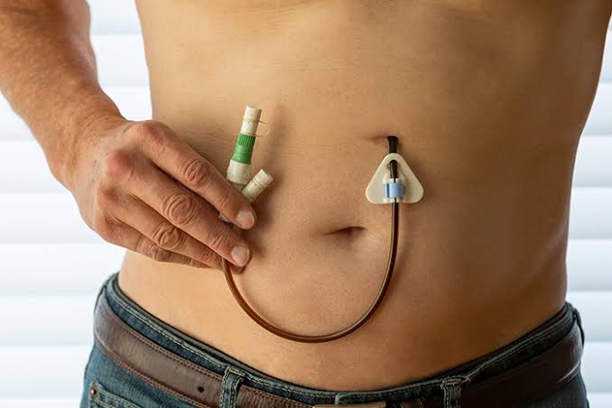 PEG tube insertion