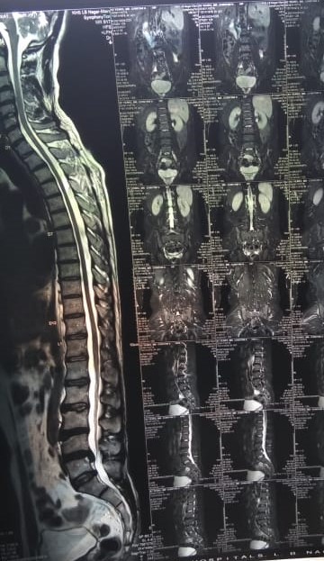 Lumbar epidural injection and endoscopic discectomy