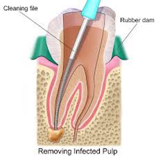Root Canal Treatment