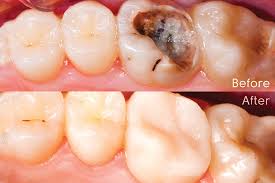 Composite Restorations