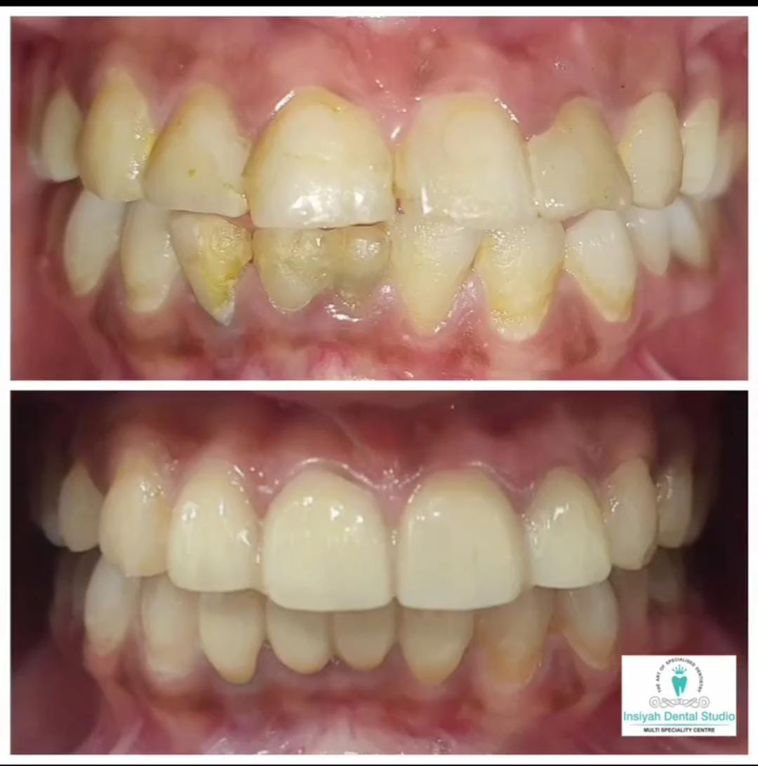 Dental Veneers