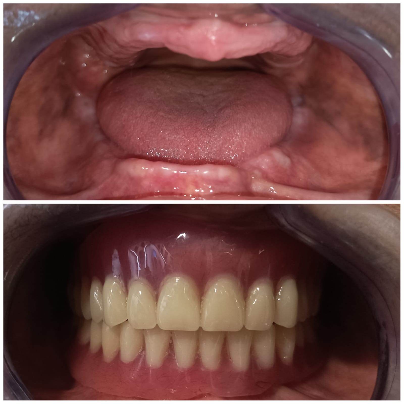 Dentures