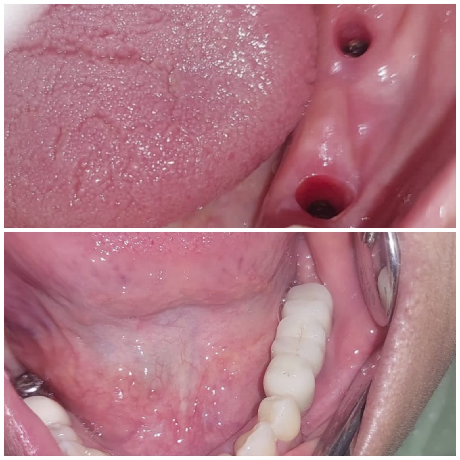 Dental Implants