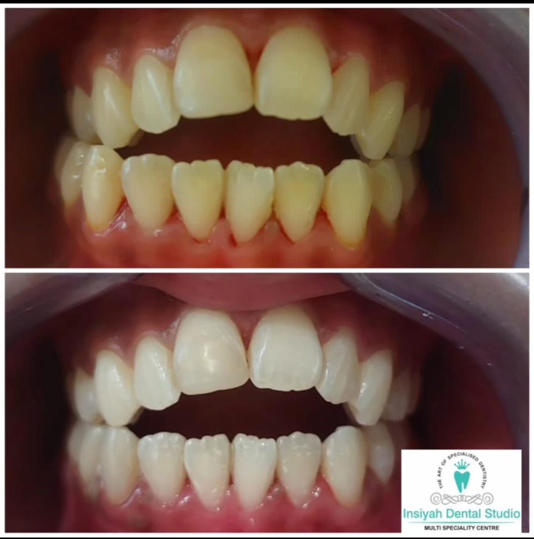 Teeth Whitenning