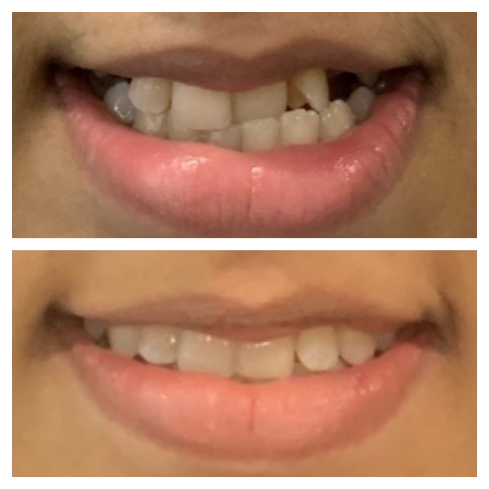 Orthodontic Braces And Aligners