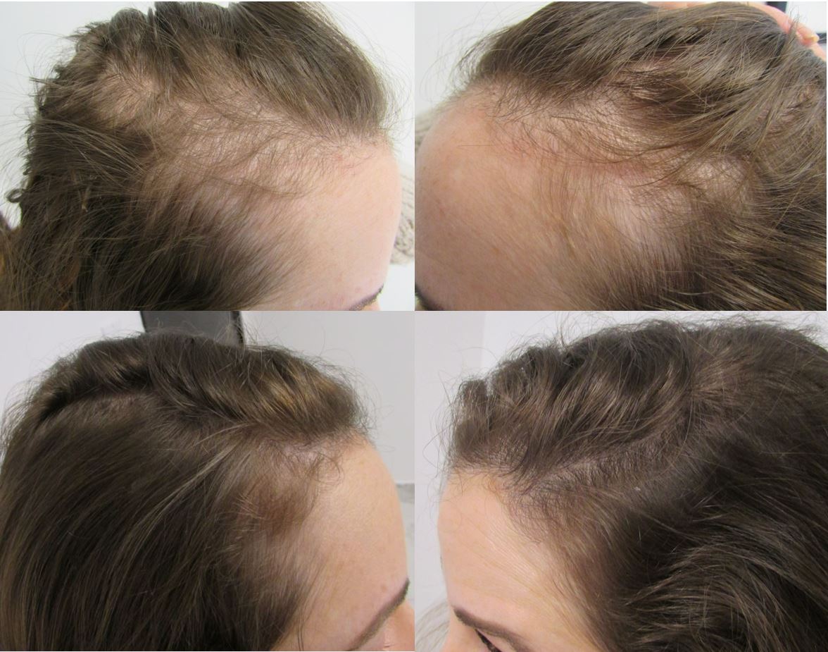 HAIR RE-GROWTH THERAPY