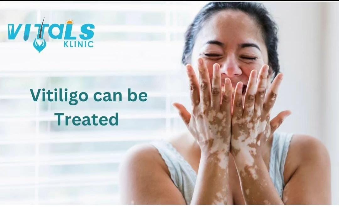 VITILIGO TREATMENT