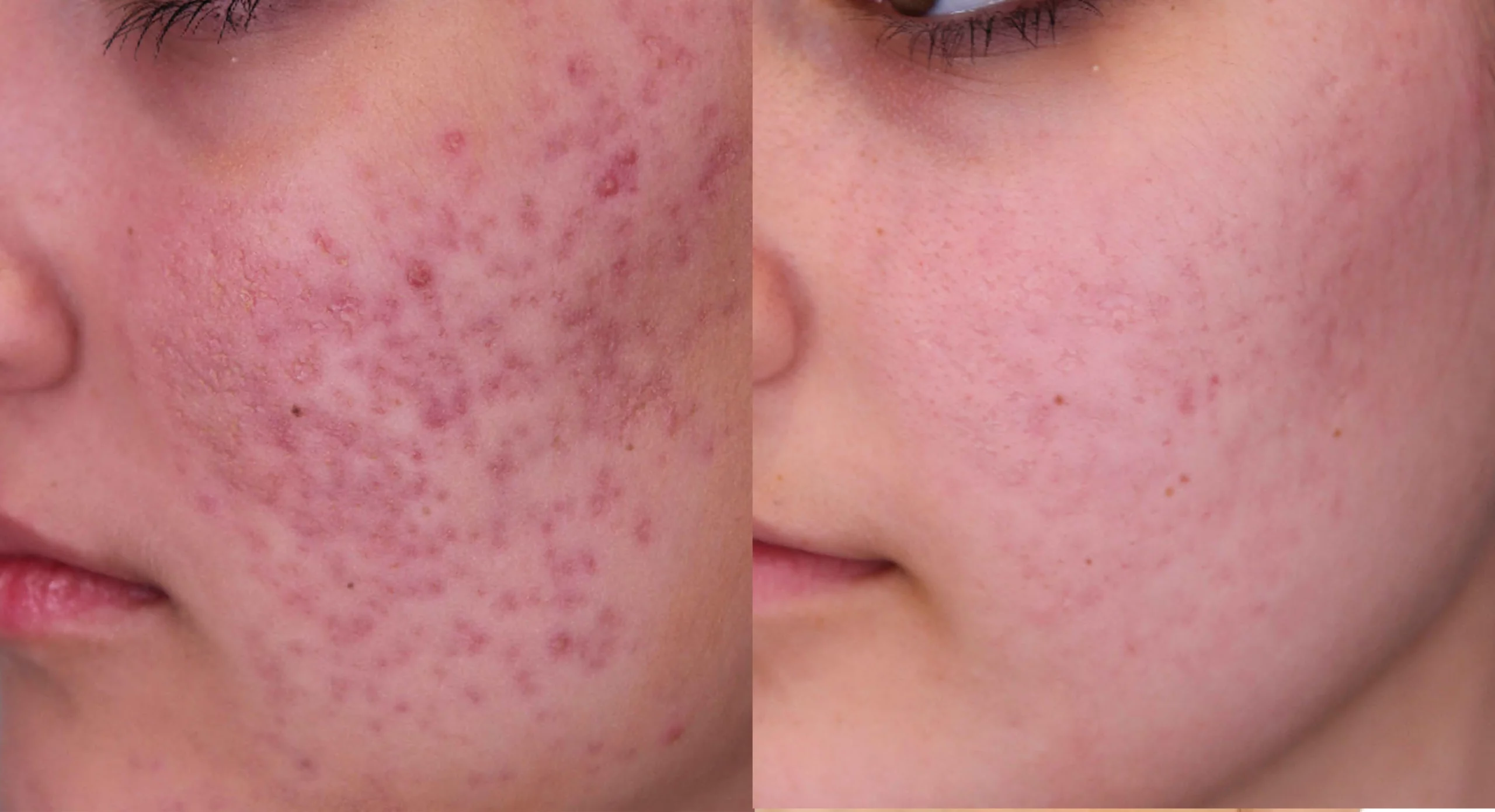 ACNE SCARS REDUCTION