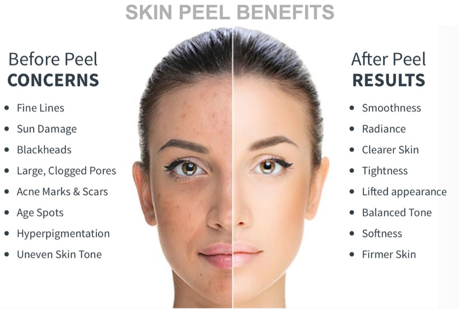 CHEMICAL PEELS