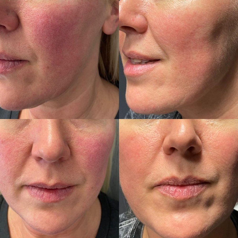 DERMA STAMPING