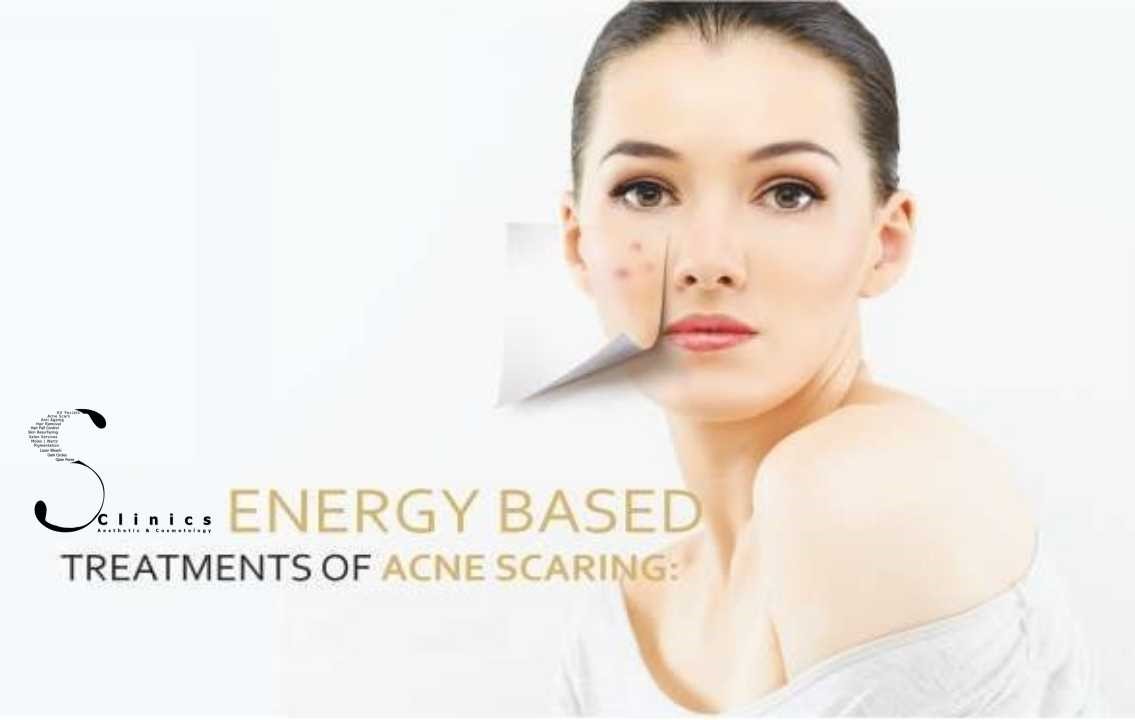 ENERGY BASED ACNE TREATMENT