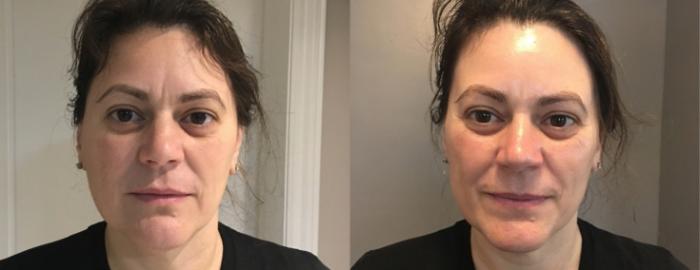 GLOW PEEL