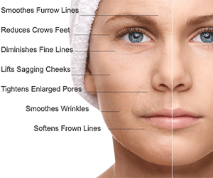 MICRONEEDLING THERAPY