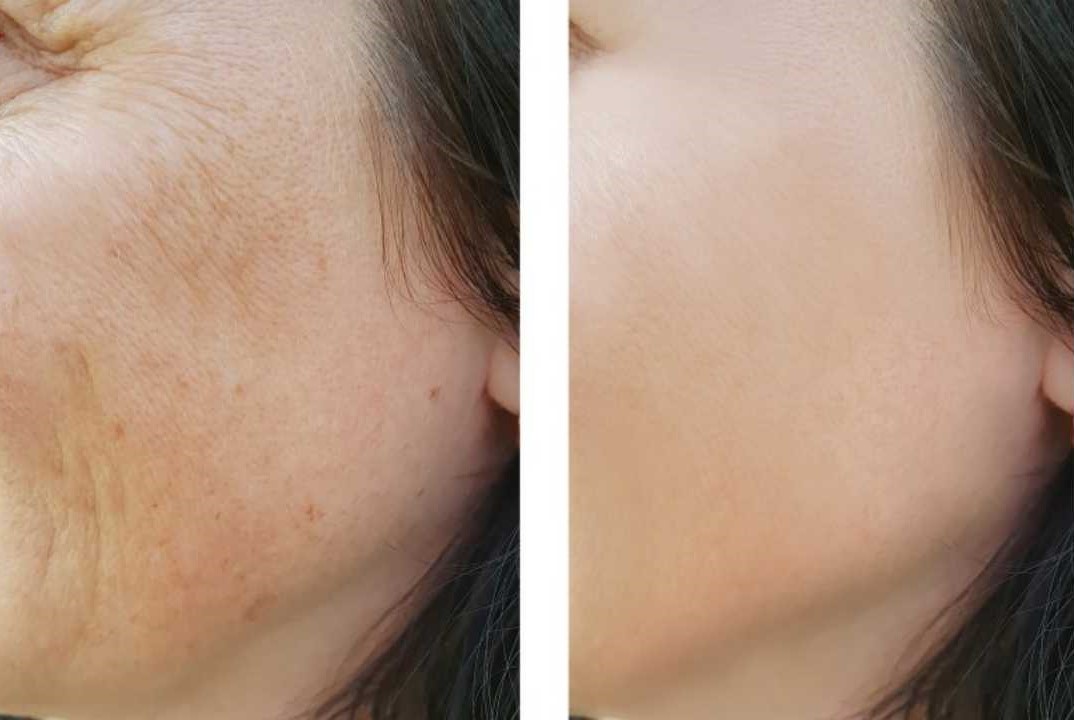 NANO NEEDLING