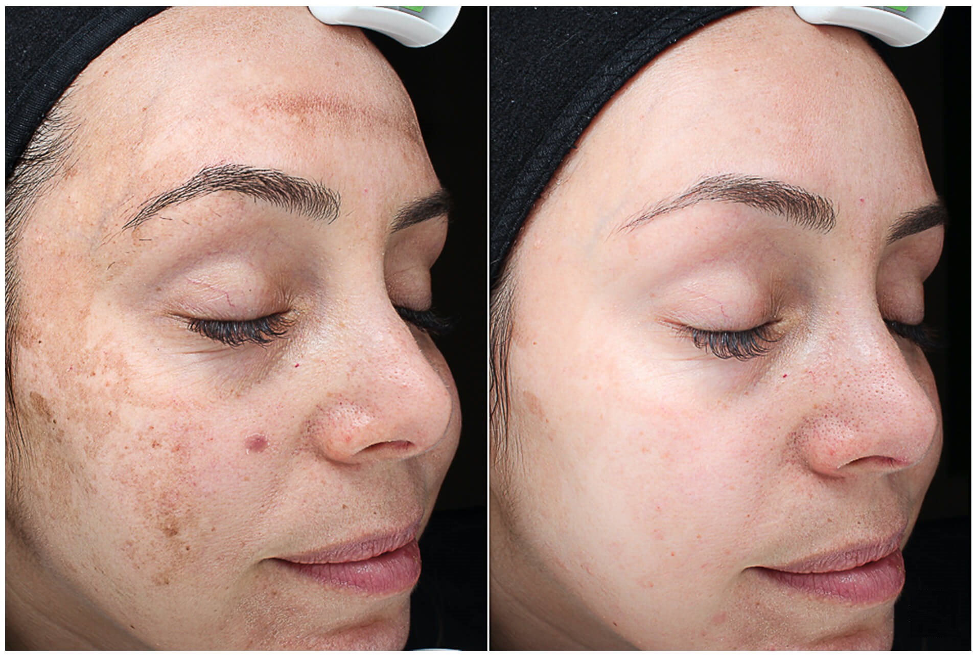 PIGMENT MELASMA REDUCTION THERAPY