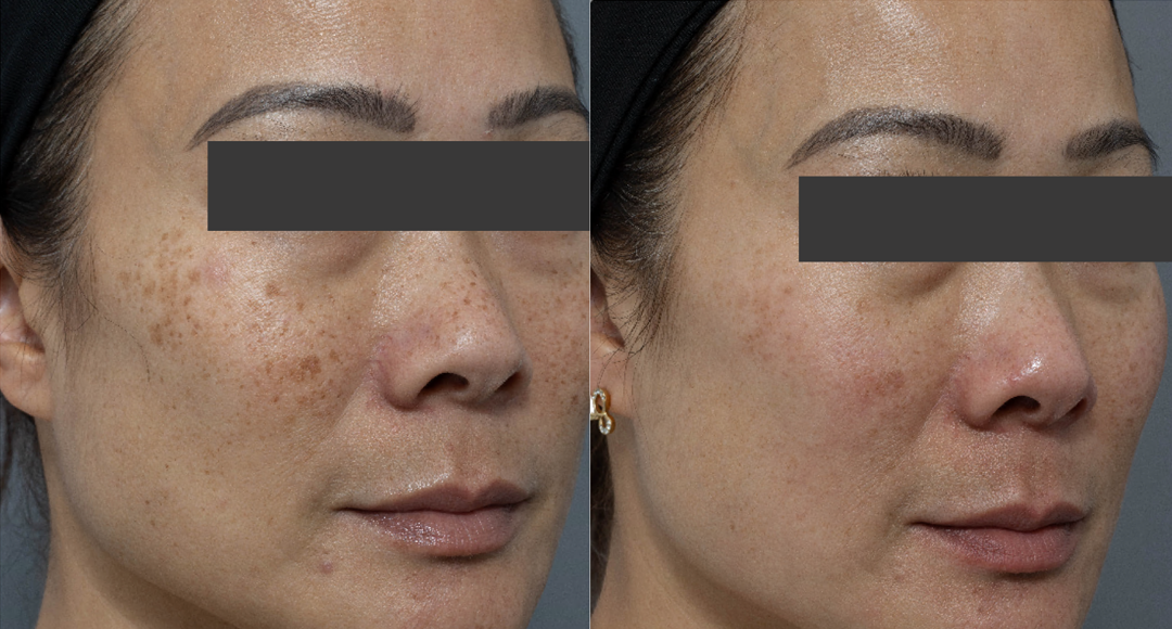 PIGMENTATION (FRECKLES) REDUCTION THERAPY