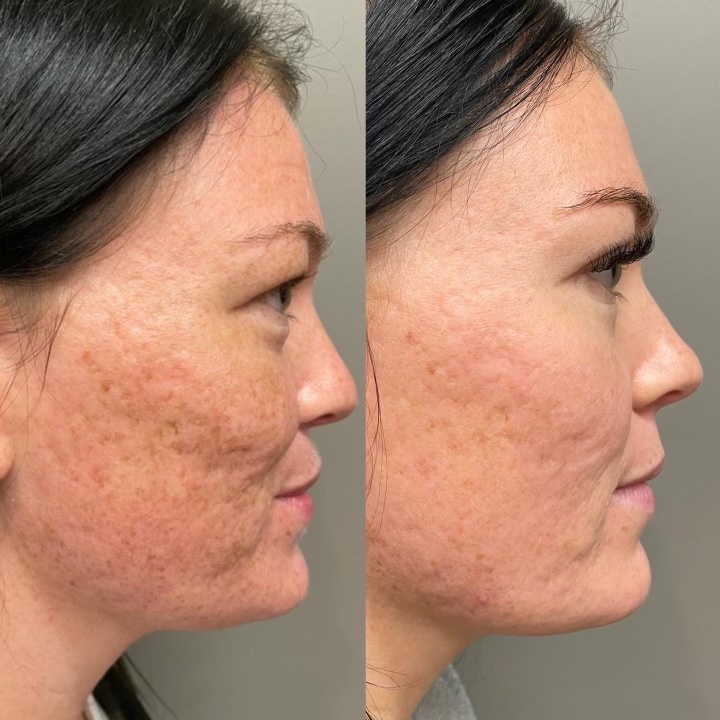 RF MICRONEEDLING