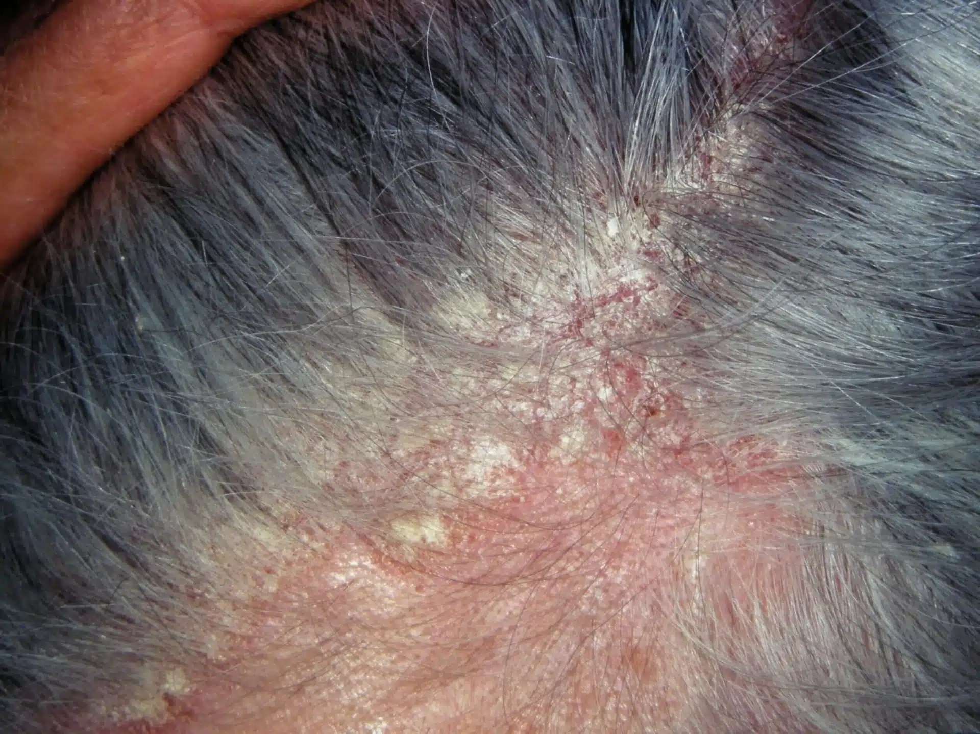SEBORRHEIC DERMATITIS THERAPY