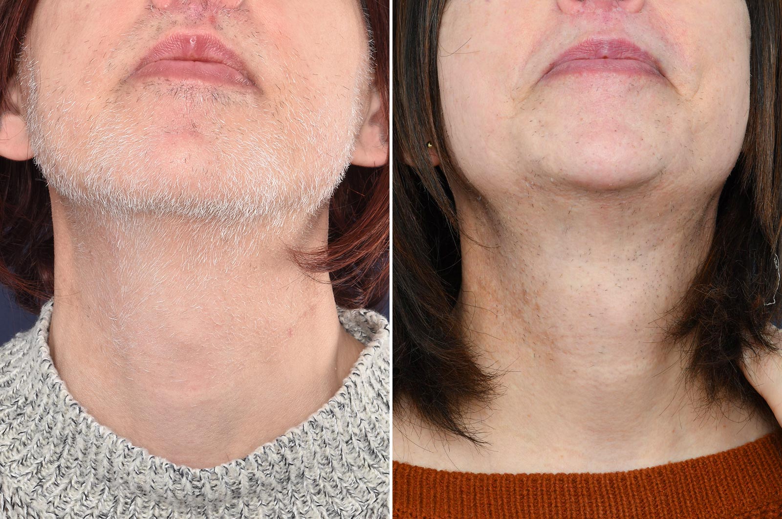 WHITE HAIR ELECTROLYSIS THERAPY