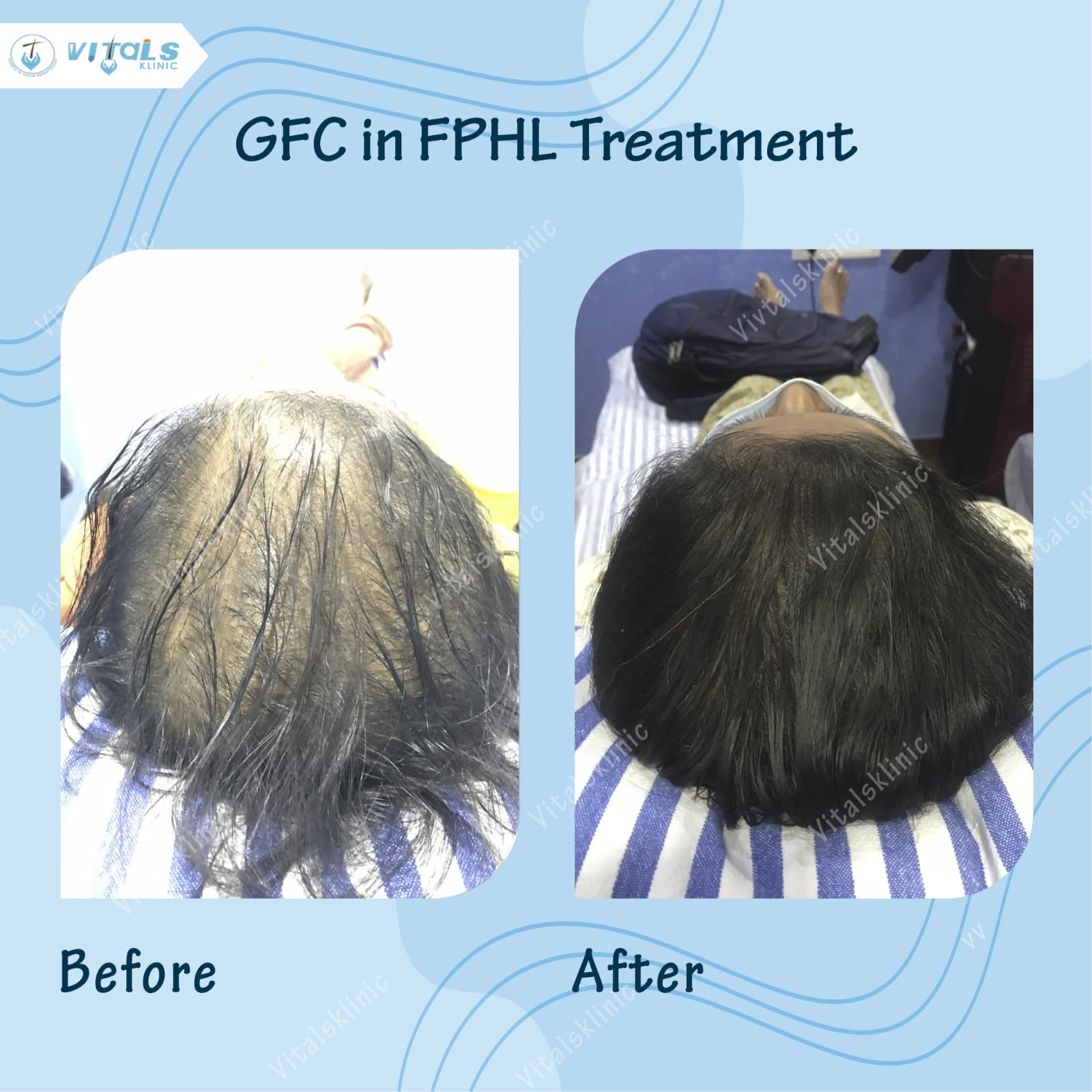Hair Transplantation