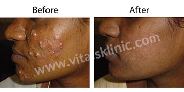ACNE/PIMPLE TREATMENT