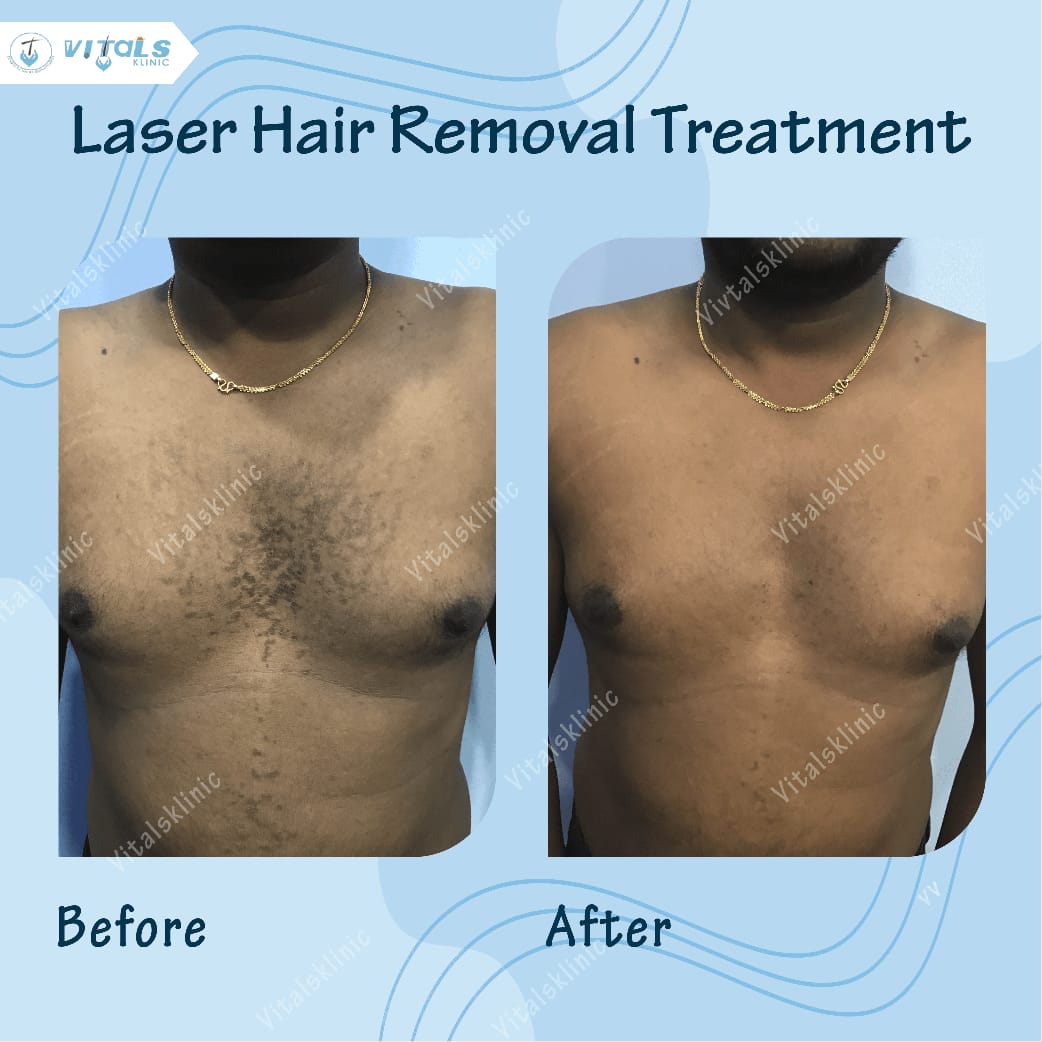 LASER HAIR REMOVAL