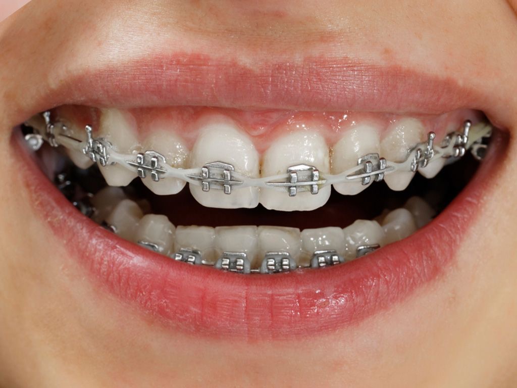 Orthodontic Treatment (Braces)