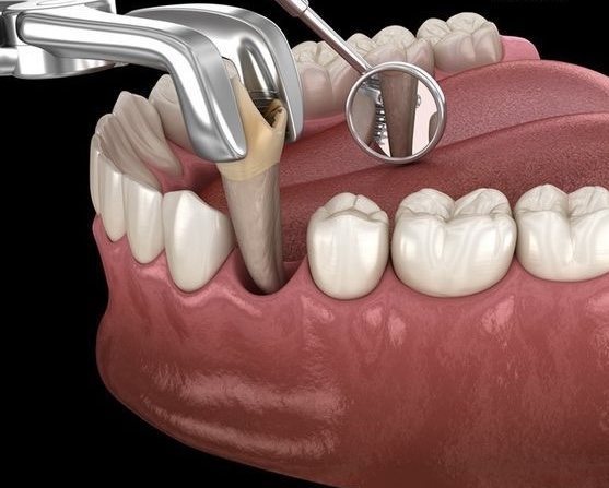 Tooth Extraction