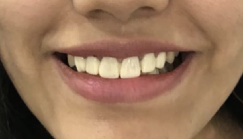 Smile Designing