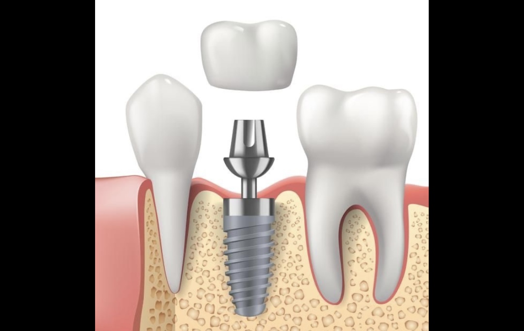 Dental Implant