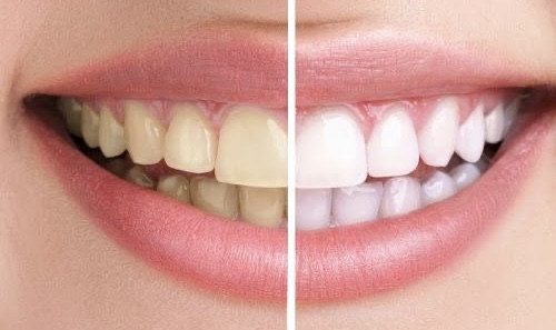 Teeth Whitening / Bleaching