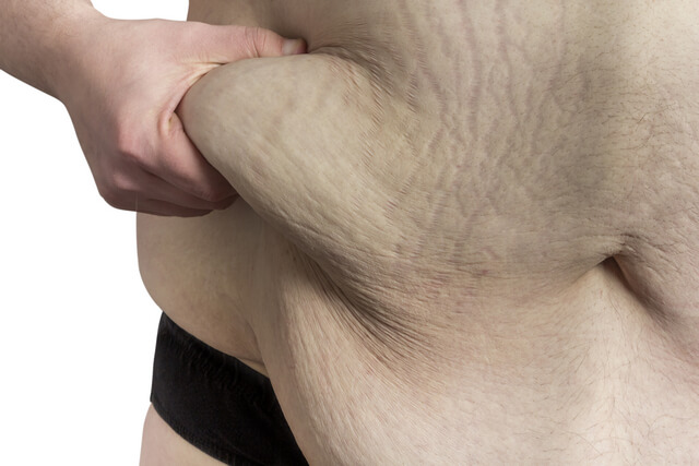 Body Contouring after Massive Weight Loss (MWL)