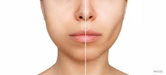 Buccal Fat Pad removal