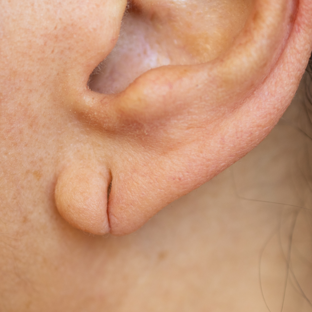 Auroplasty (ELR)
