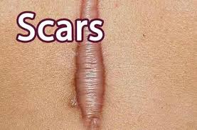 Scar Management