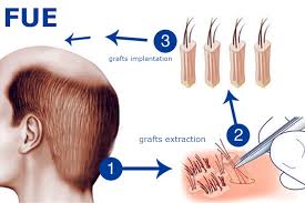 Hair Transplantation