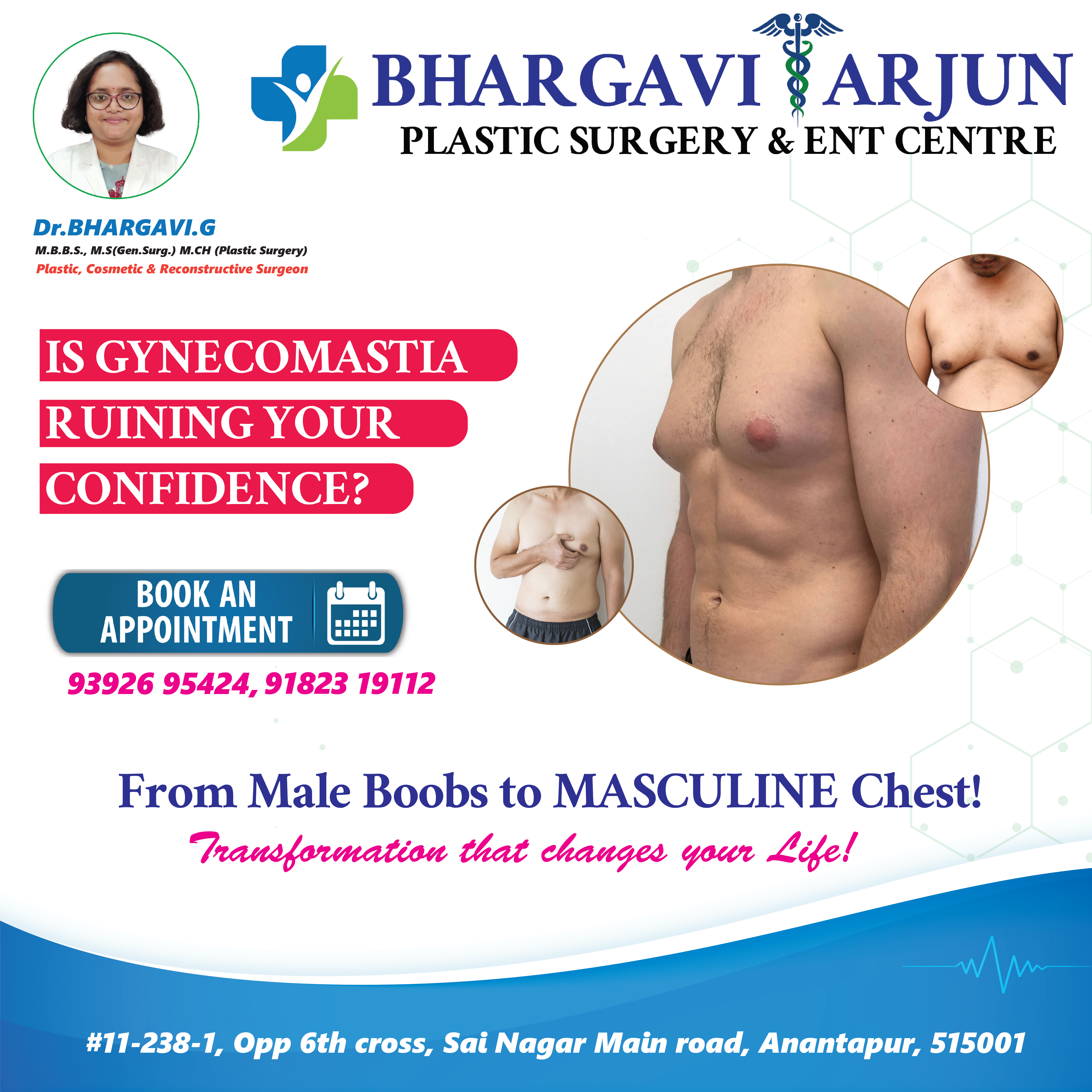 Gynecomastia